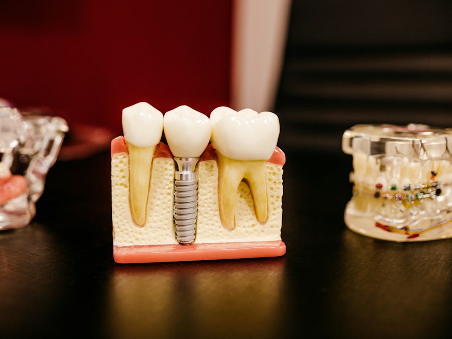 Same-day ceramic crown being placed